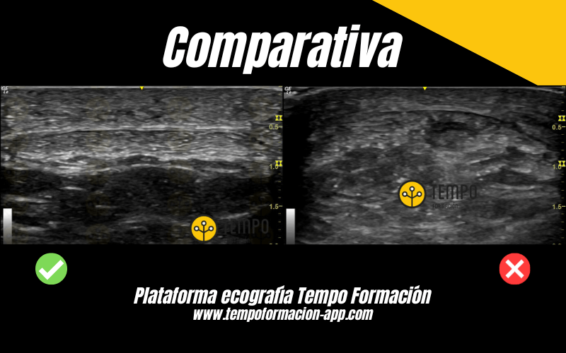 4. Comparativa Corte Transversal Ecografia Tempo Formacion.png